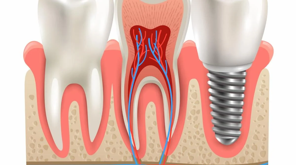 Trồng răng Implant