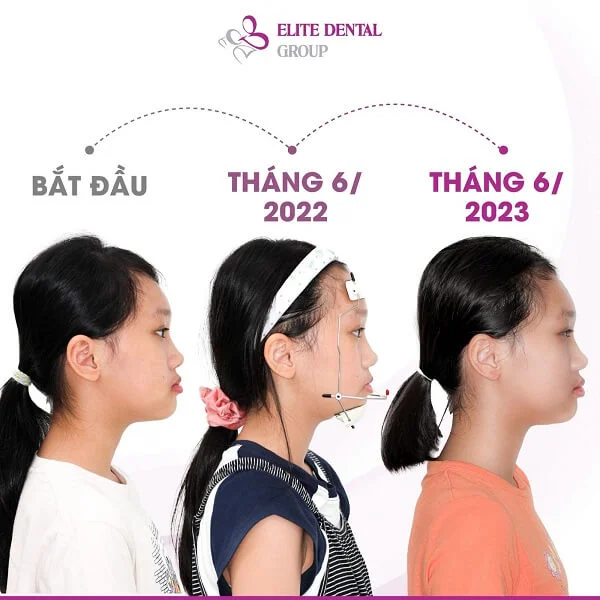 tien-trinh-chinh-mom-cua-be